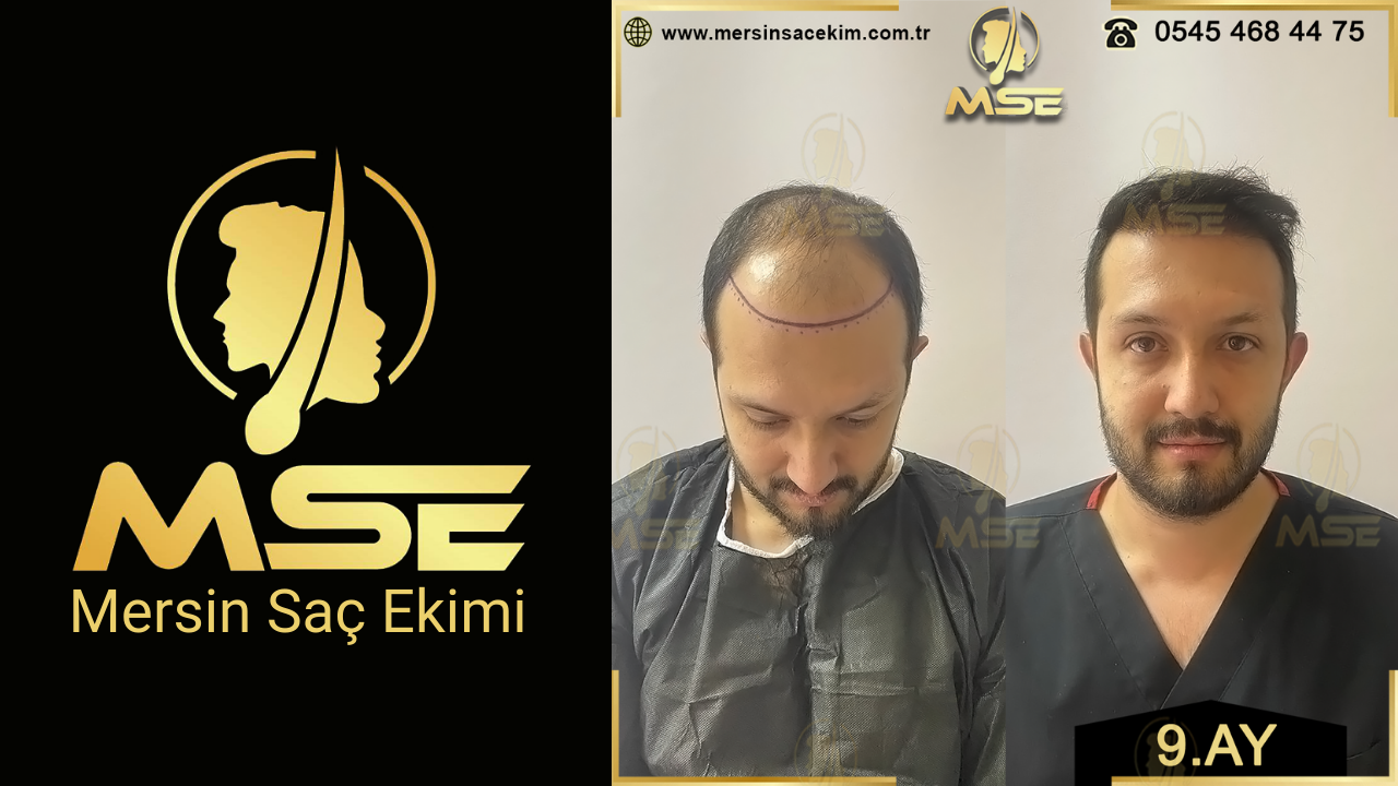 Mersin Saç Ekimi